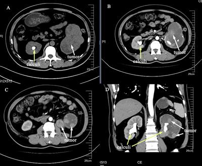 Case Report: A MiT family translocation renal cell carcinoma in the renal pelvis, calyces and upper ureter misdiagnosed as upper tract urothelial carcinoma